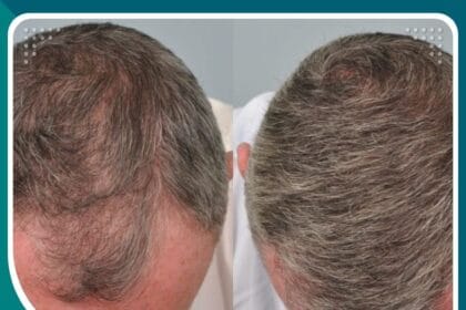 تقنية الإقتطاف الدقيق Nano Fue في زراعة الشعر
