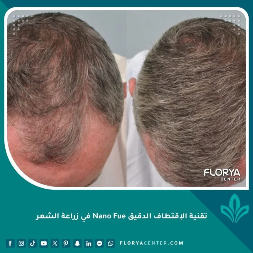 تقنية الإقتطاف الدقيق Nano Fue في زراعة الشعر