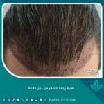 تقنية زراعة الشعر من دون حلاقة