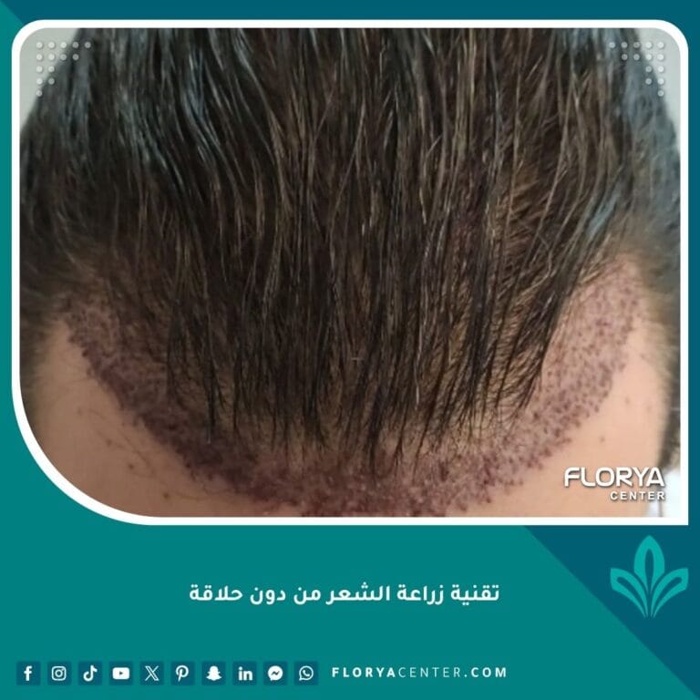 تقنية زراعة الشعر من دون حلاقة