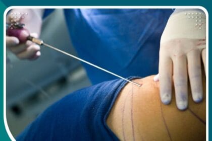 عملية شفط الدهون