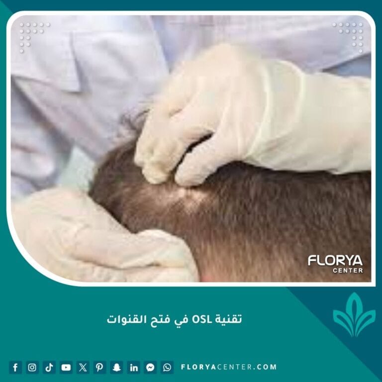 تقنية OSL في فتح القنوات