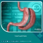 عملية تكميم المعدة