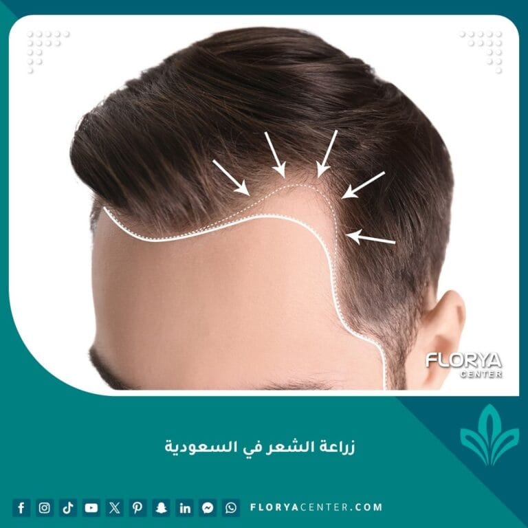 زراعة الشعر في السعودية
