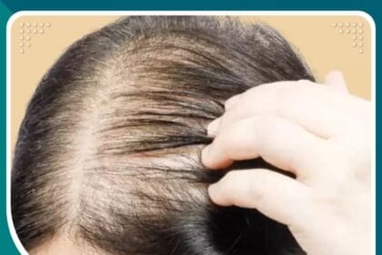 زراعة الشعر للنساء في تركيا