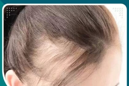 زراعة الشعر للمرأة