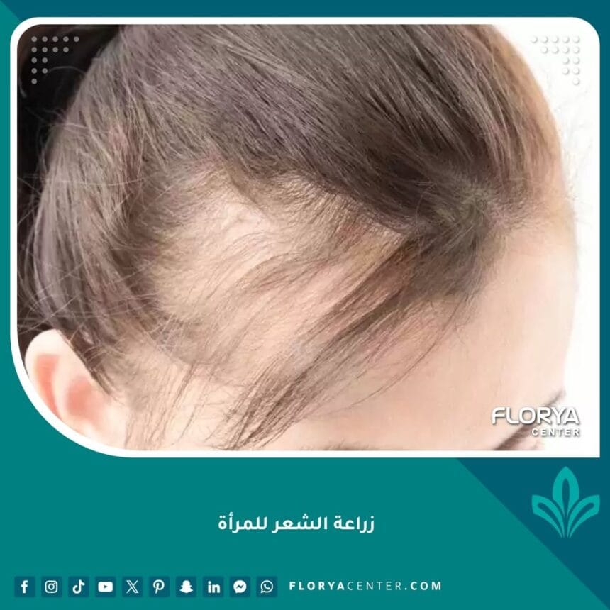 زراعة الشعر للمرأة 1 زراعة الشعر للمرأة