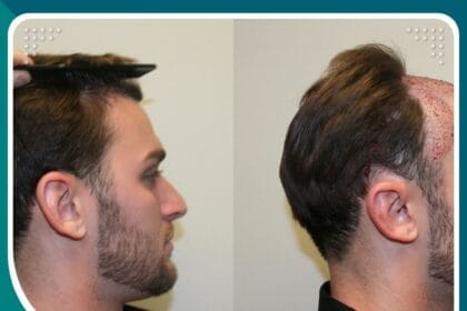 استخدام التكنولوجيا الحديثة في عمليات زراعة الشعر بالاقتطاف