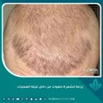 زراعة الشعر 8 خطوات من داخل غرفة العمليات