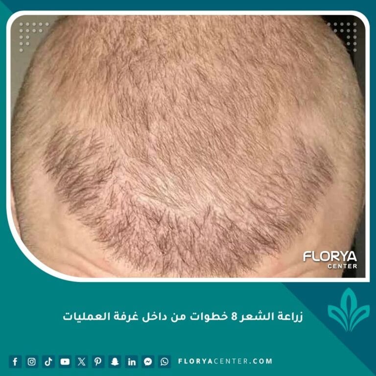 زراعة الشعر 8 خطوات من داخل غرفة العمليات