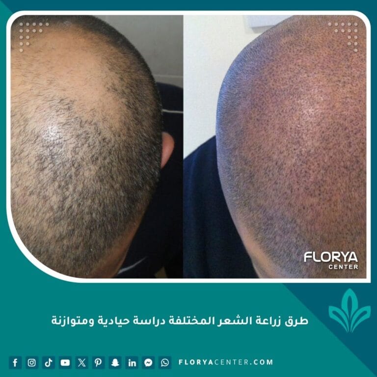 طرق زراعة الشعر المختلفة دراسة حيادية ومتوازنة