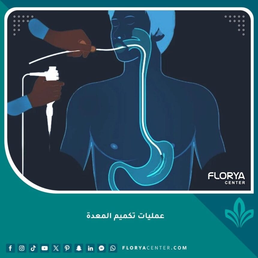 عمليات تكميم المعدة