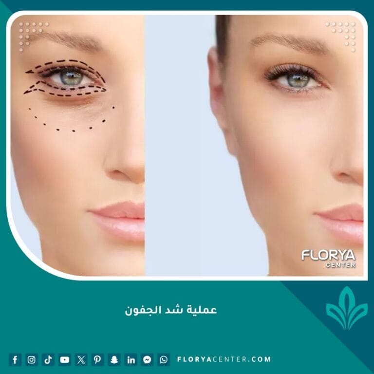 عملية شد الجفون