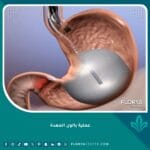 عملية بالون المعدة