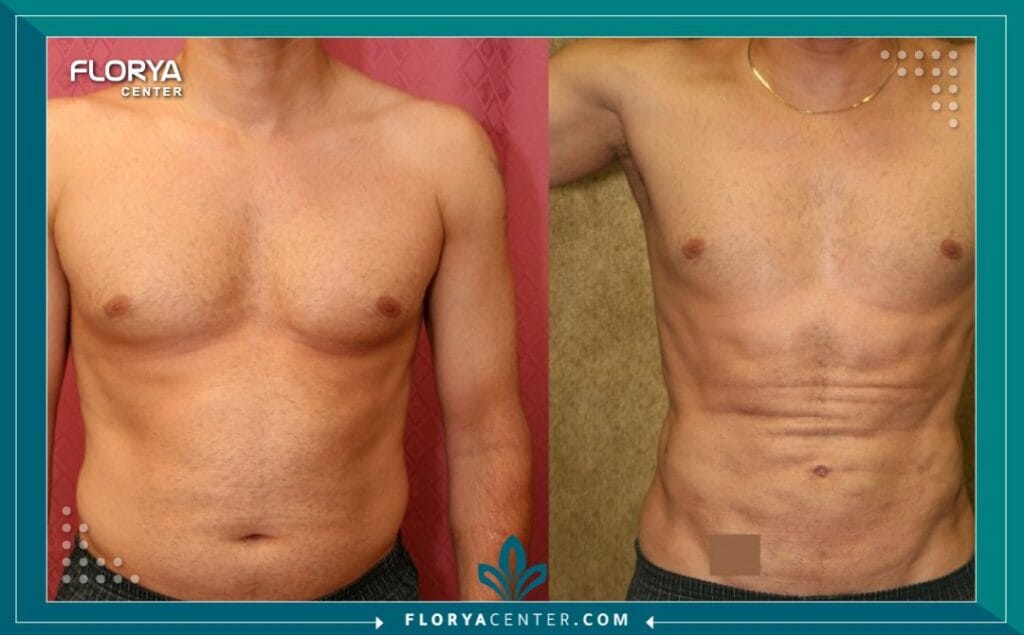 شفط دهون البطن