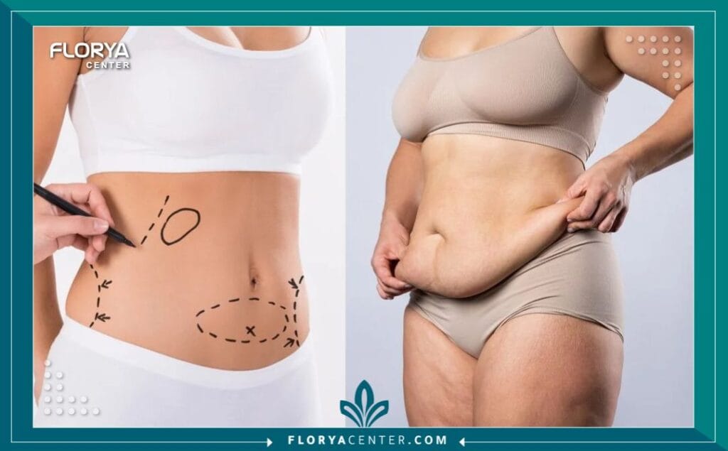 شفط دهون البطن