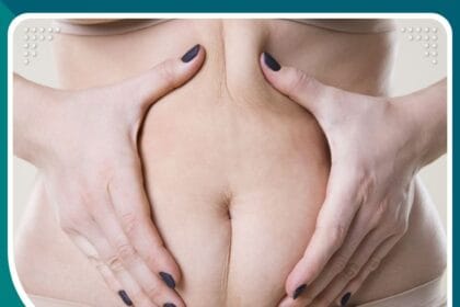 ترهلات البطن الأسباب وطرق العلاج