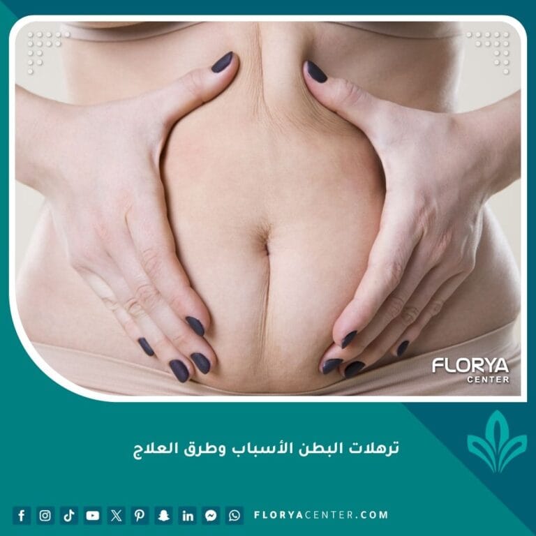 ترهلات البطن الأسباب وطرق العلاج