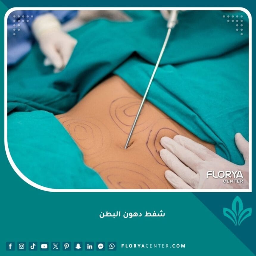 شفط دهون البطن