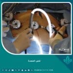 عملية قص المعدة