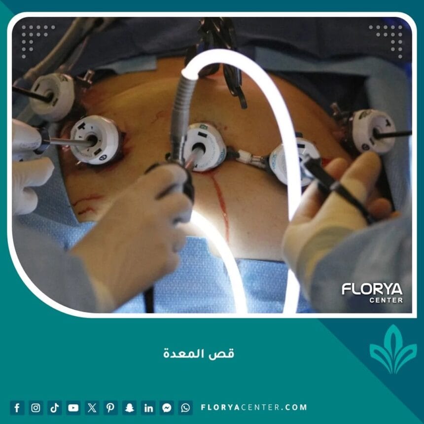 عملية قص المعدة