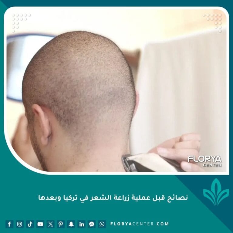 نصائح قبل عملية زراعة الشعر في تركيا وبعدها