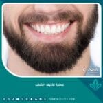 عملية تكثيف الشنب