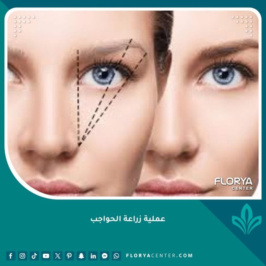 عملية زراعة الحواجب