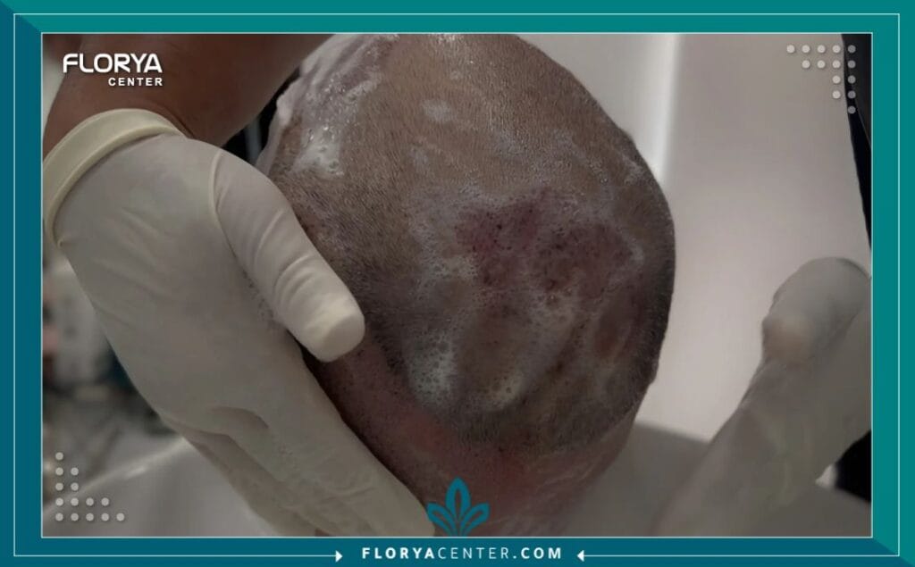 غسل الشعر بعد زراعة الشعر بالتفصيل