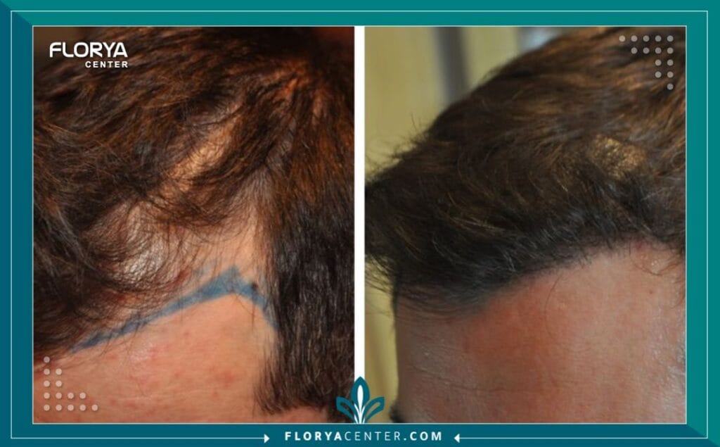 الكولاجين للشعر