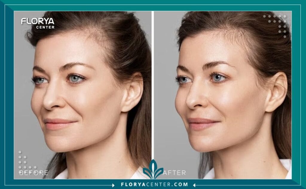 بوتكس الشفاه