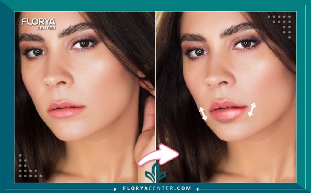 بوتكس الشفاه