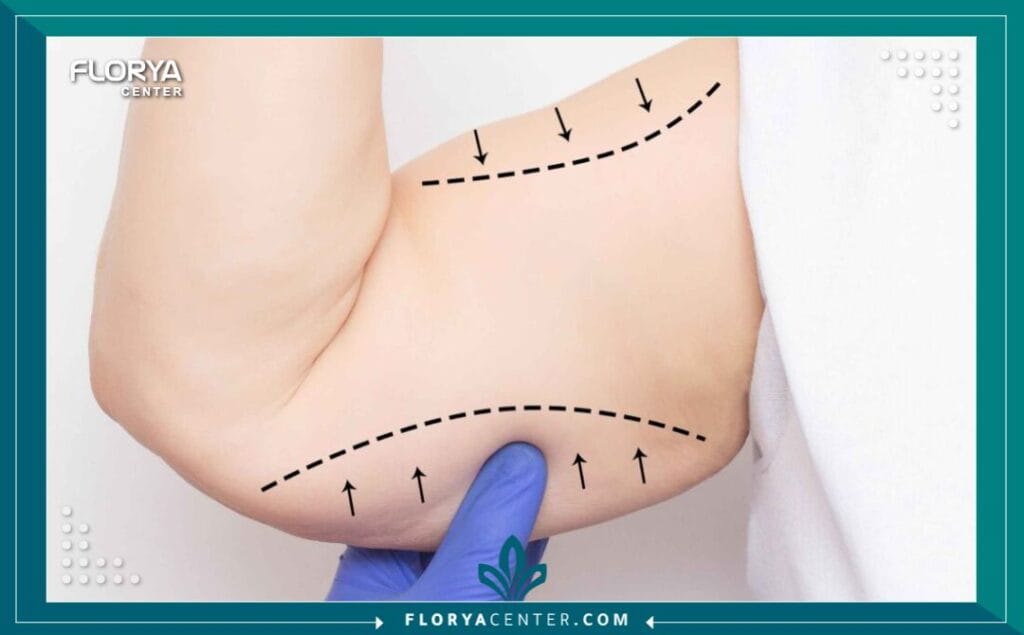 تجميل الذراعين