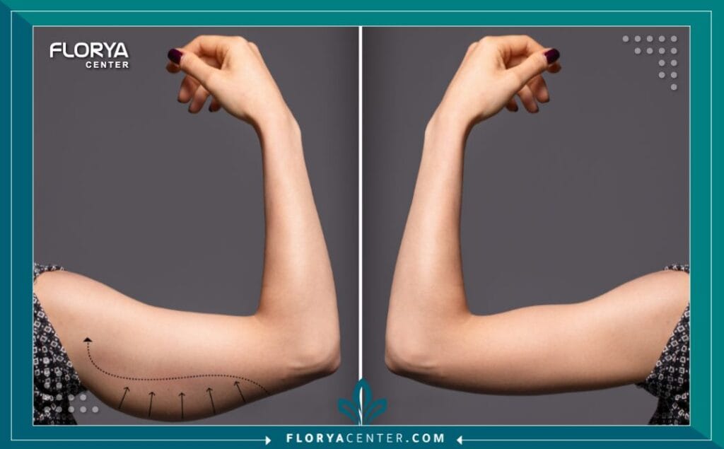 تجميل الذراعين