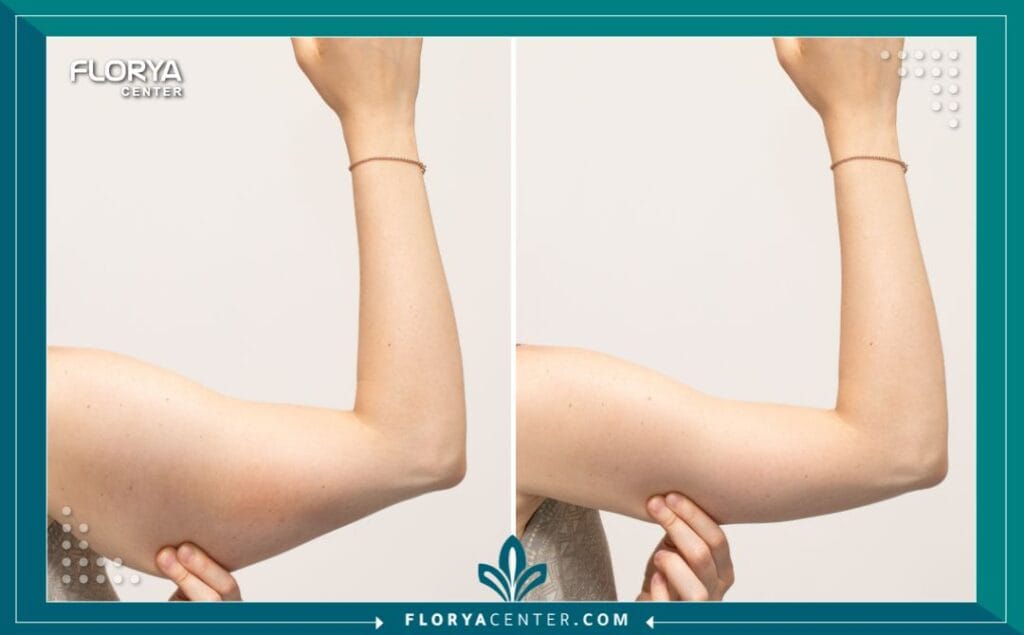 تجميل الذراعين