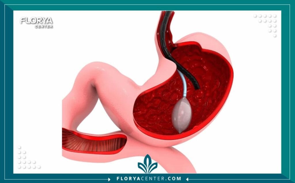 شفط الدهون بالفيزر