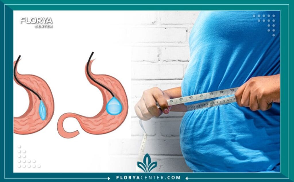 شفط الدهون بالفيزر