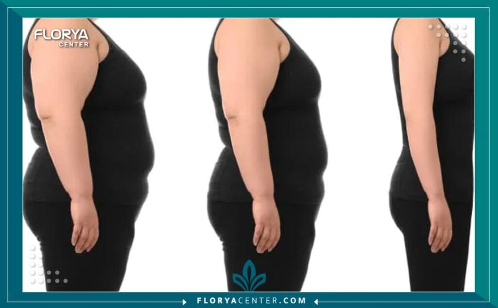 شفط الدهون بالفيزر