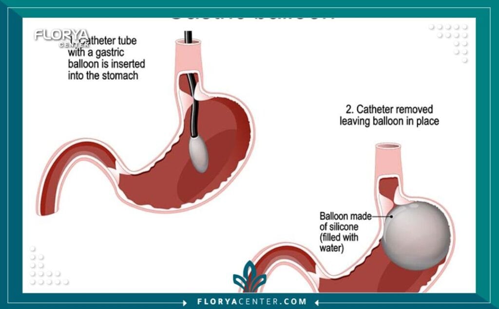 عملية بالون المعدة