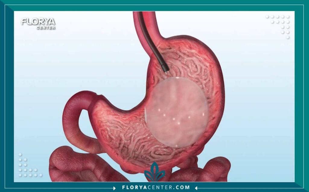 عملية بالون المعدة