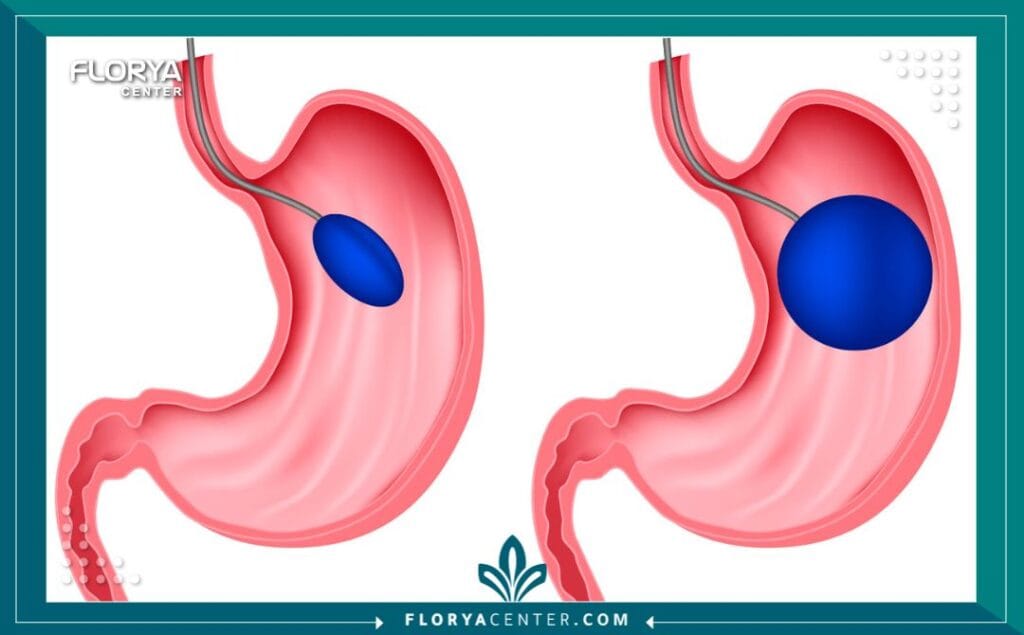 عملية بالون المعدة