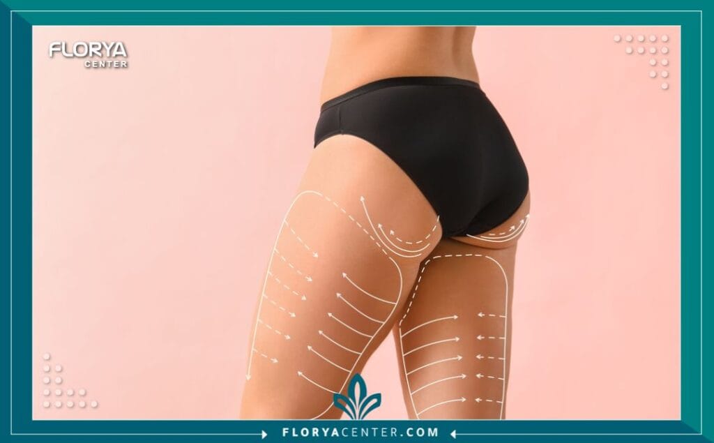 عملية شد الأفخاذ