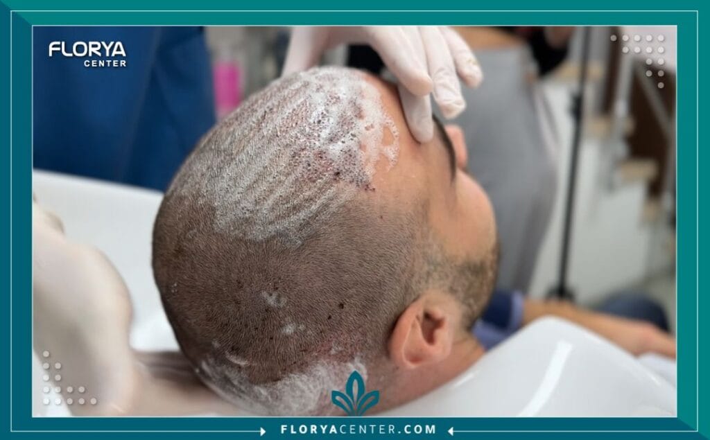 غسل الشعر بعد زراعة الشعر بالتفصيل