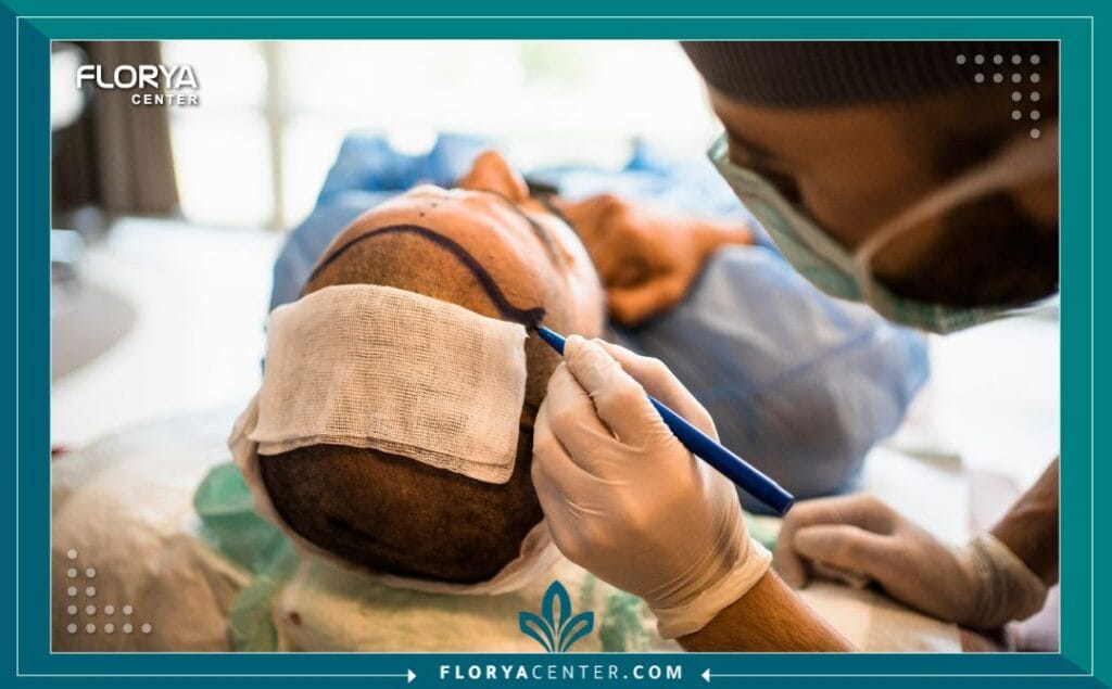 غسل الشعر بعد زراعة الشعر بالتفصيل