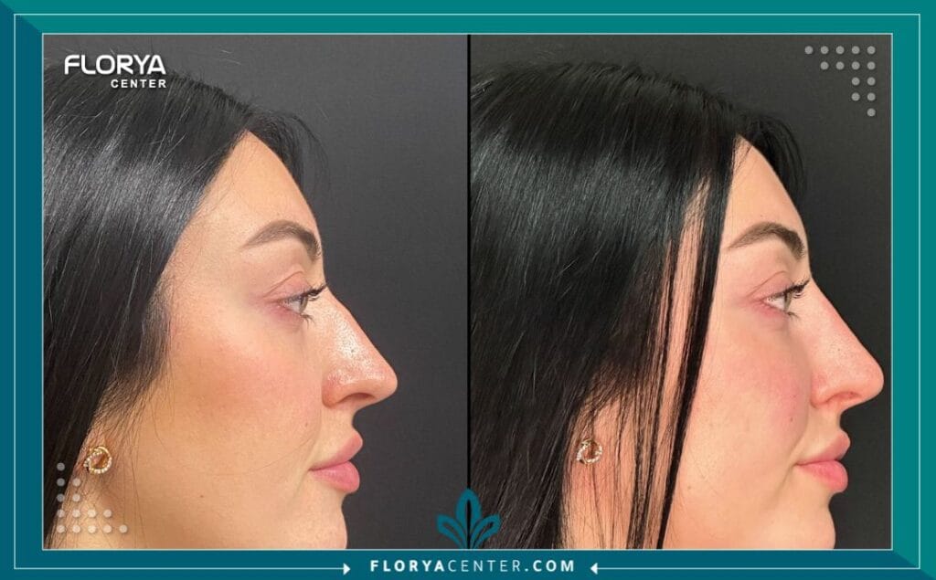 فيلر الأنف مشاكل الأنف التجميلية 2 - فيلر الأنف مشاكل الأنف التجميلية فيلر الأنف ومن المرشحون لتنفيذ تجميل الأنف بالإبر، مشاكل الأنف التجميلية، أضرار تجميل الأنف بالفيلر، المرشحون لتنفيذ تجميل الأنف بالإبر