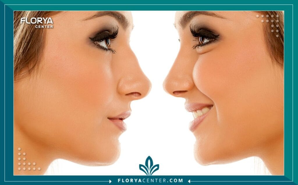 فيلر الأنف