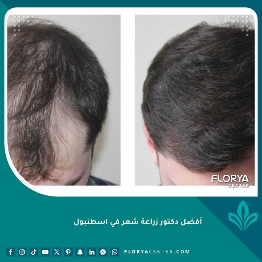 أفضل دكتور زراعة شعر في اسطنبول