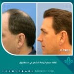 تكلفة عملية زراعة الشعر في اسطنبول