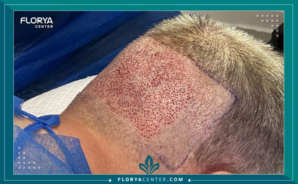 المنطقة المانحة في عملية زراعة الشعر 2 المنطقة المانحة في عملية زراعة الشعر