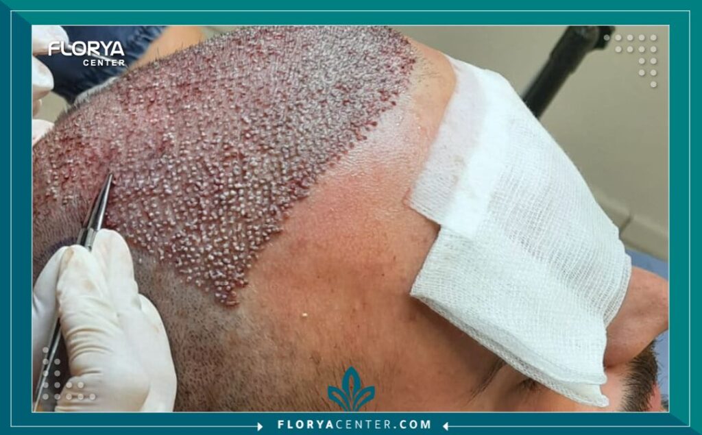المنطقة المانحة في عملية زراعة الشعر 4 المنطقة المانحة في عملية زراعة الشعر
